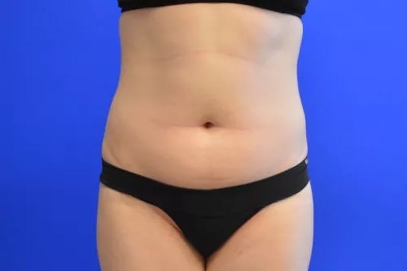 Liposuction Before & After Gallery - Patient 341430 - Image 1