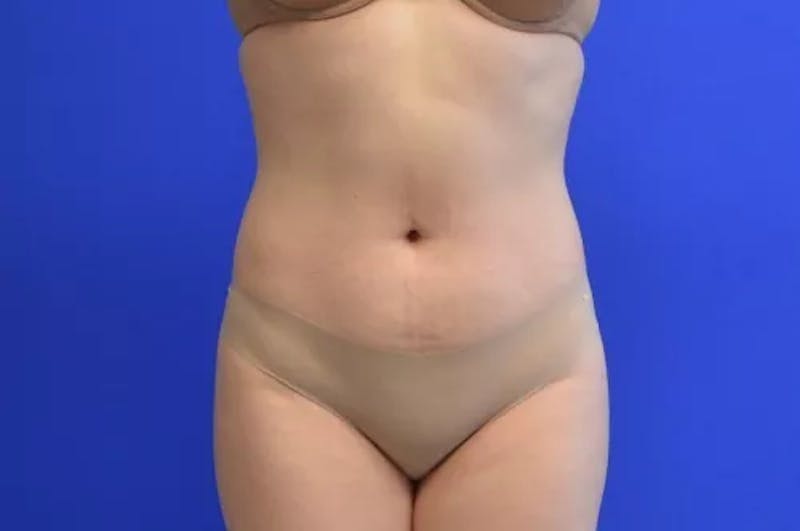 Liposuction Before & After Gallery - Patient 341430 - Image 2