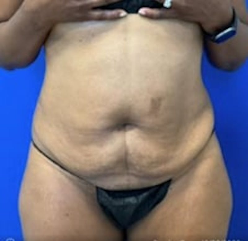 Drainless Tummy Tuck Before & After Gallery - Patient 281118 - Image 1