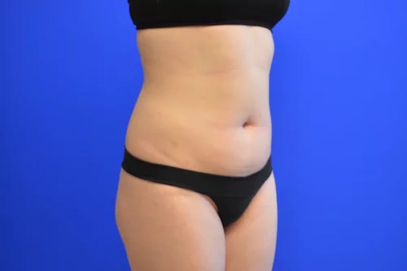 Liposuction Before & After Gallery - Patient 341430 - Image 3