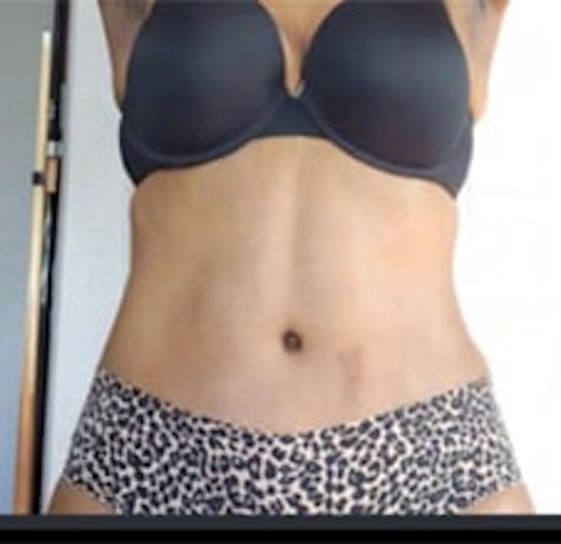Drainless Tummy Tuck Before & After Gallery - Patient 281118 - Image 2