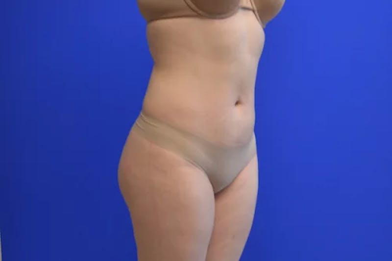 Liposuction Before & After Gallery - Patient 341430 - Image 4