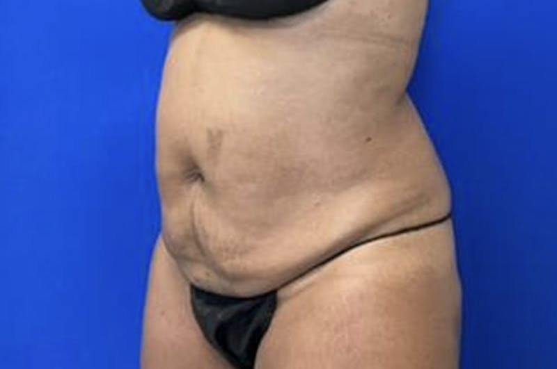 Drainless Tummy Tuck Before & After Gallery - Patient 281118 - Image 3