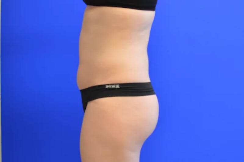 Liposuction Before & After Gallery - Patient 341430 - Image 5