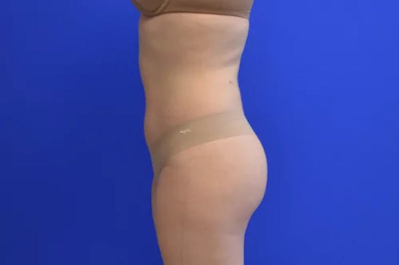 Liposuction Before & After Gallery - Patient 341430 - Image 6