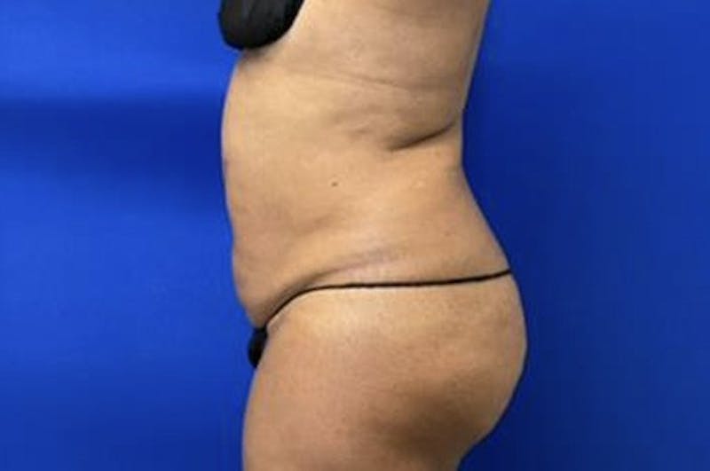 Drainless Tummy Tuck Before & After Gallery - Patient 281118 - Image 5
