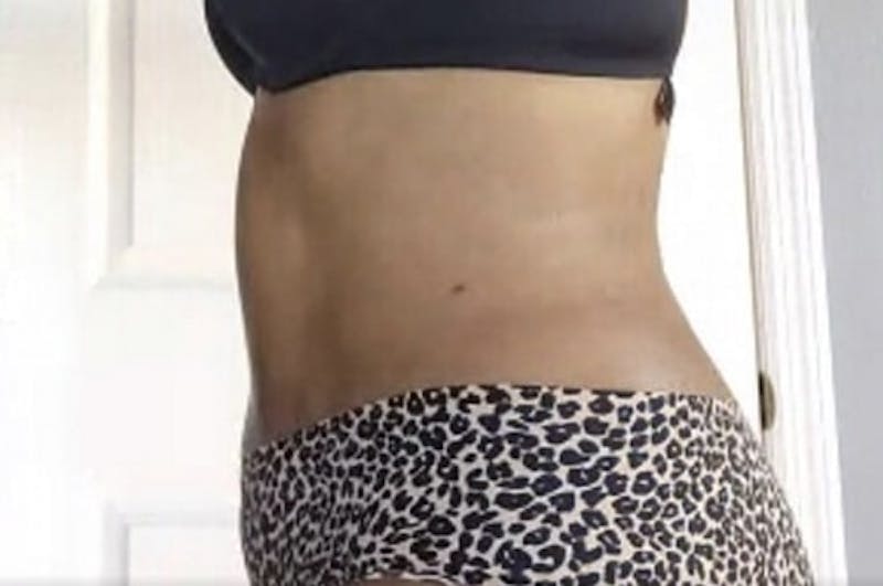 Drainless Tummy Tuck Before & After Gallery - Patient 281118 - Image 6
