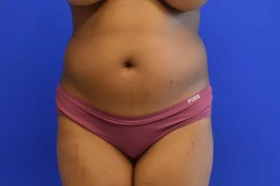Liposuction Before & After Gallery - Patient 765695 - Image 1