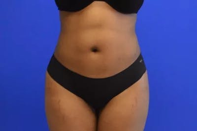 Liposuction Before & After Gallery - Patient 765695 - Image 2