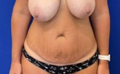 Drainless Tummy Tuck Before & After Gallery - Patient 154275 - Image 1