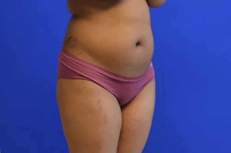 Liposuction Before & After Gallery - Patient 765695 - Image 3