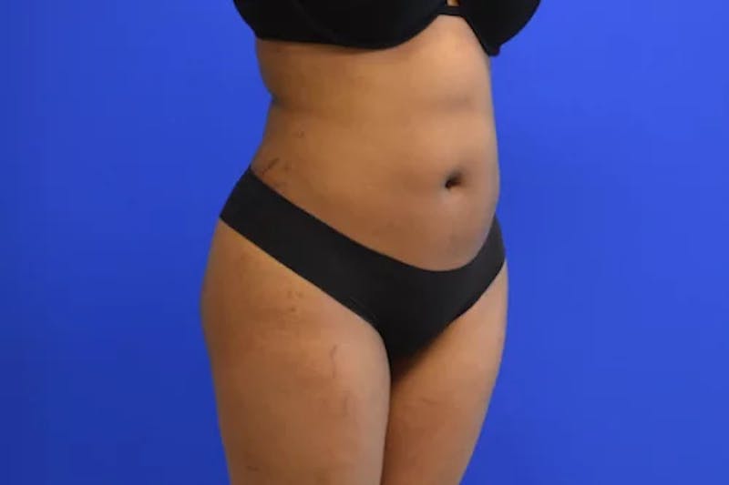 Liposuction Before & After Gallery - Patient 765695 - Image 4