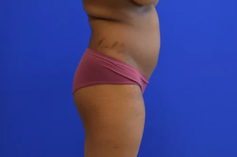 Liposuction Before & After Gallery - Patient 765695 - Image 5