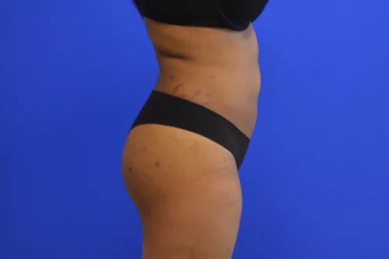Liposuction Before & After Gallery - Patient 765695 - Image 6