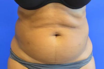 Liposuction Before & After Gallery - Patient 584583 - Image 1