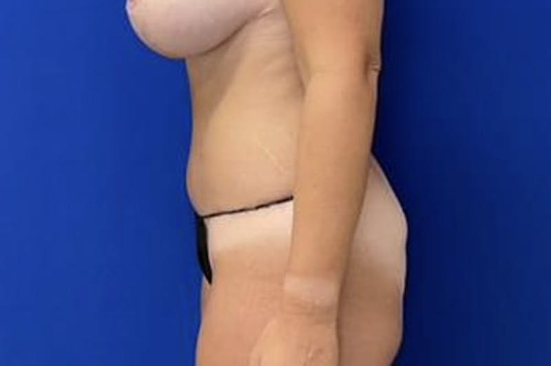 Drainless Tummy Tuck Before & After Gallery - Patient 154275 - Image 6