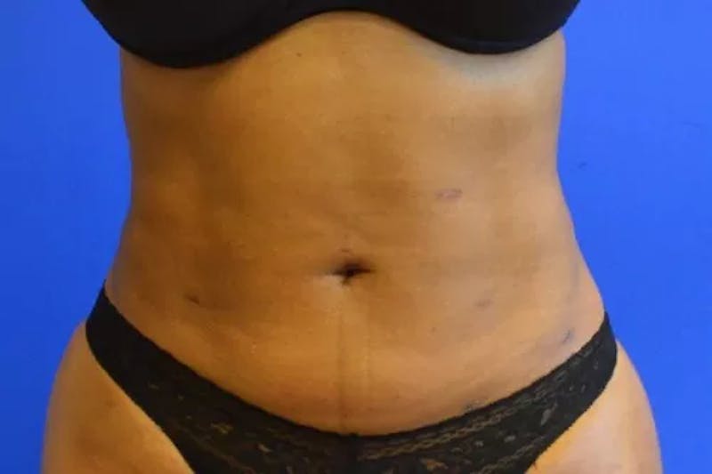Liposuction Before & After Gallery - Patient 584583 - Image 2