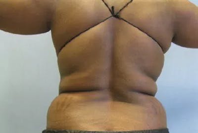 Back/Bra Roll Before & After Gallery - Patient 404832 - Image 1