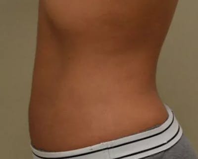 Liposuction Before & After Gallery - Patient 390340 - Image 2