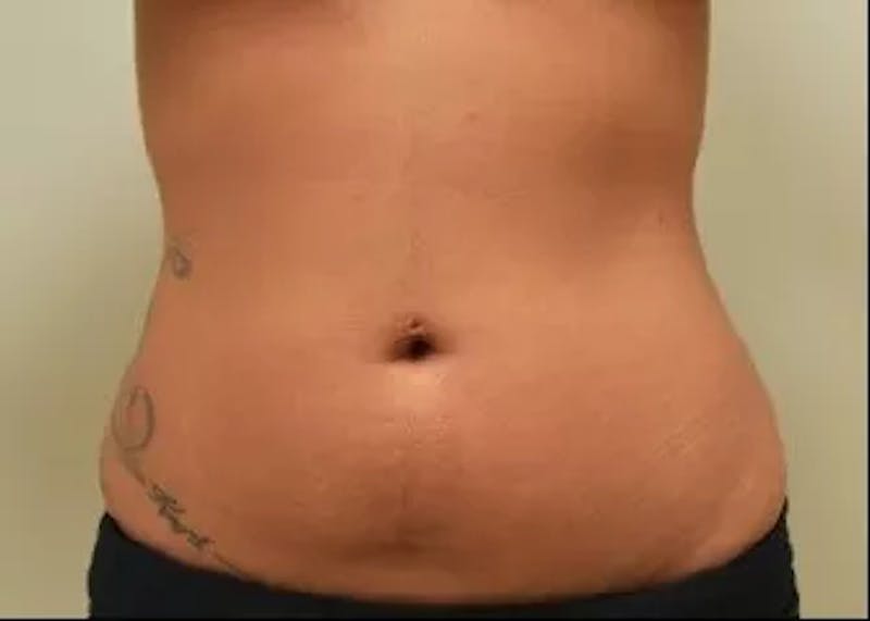 Liposuction Before & After Gallery - Patient 390340 - Image 3