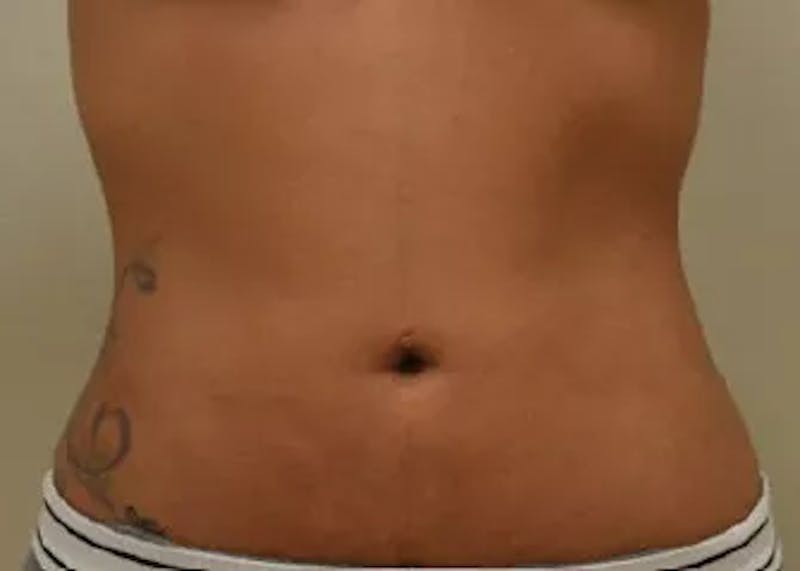 Liposuction Before & After Gallery - Patient 390340 - Image 4