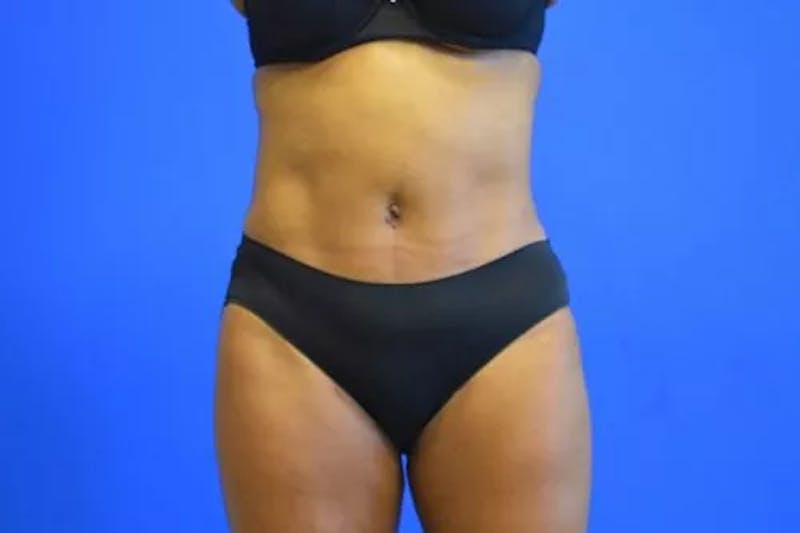 Drainless Tummy Tuck Before & After Gallery - Patient 392641 - Image 2
