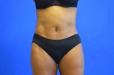 Drainless Tummy Tuck Before & After Gallery - Patient 392641 - Image 2