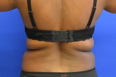 Back/Bra Roll Before & After Gallery - Patient 176025 - Image 1