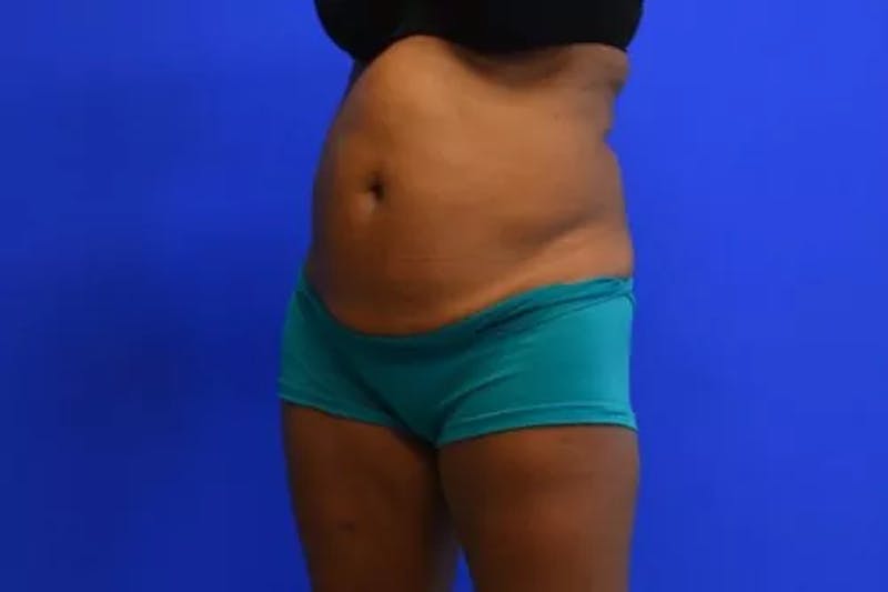 Drainless Tummy Tuck Before & After Gallery - Patient 392641 - Image 3