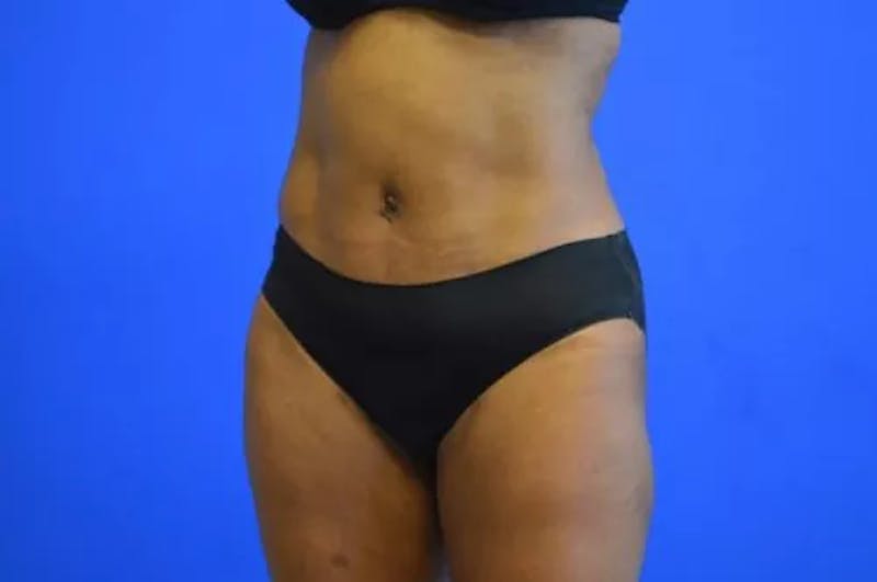 Drainless Tummy Tuck Before & After Gallery - Patient 392641 - Image 4
