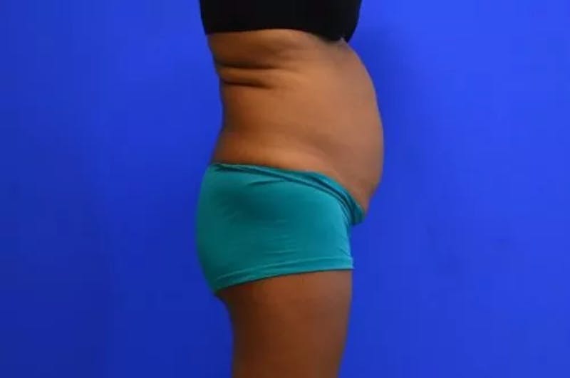 Drainless Tummy Tuck Before & After Gallery - Patient 392641 - Image 5