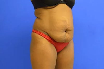Drainless Tummy Tuck Before & After Gallery - Patient 231578 - Image 1