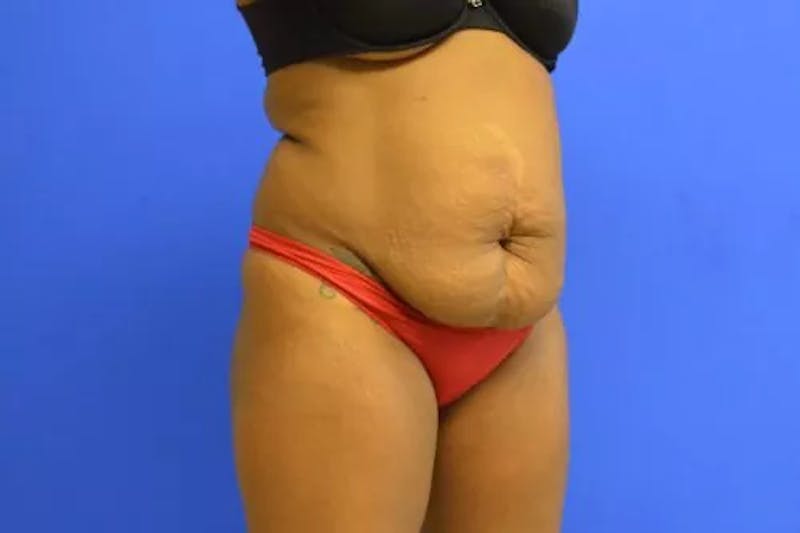 Drainless Tummy Tuck Before & After Gallery - Patient 231578 - Image 1