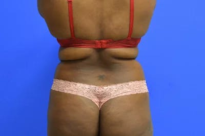 Back/Bra Roll Before & After Gallery - Patient 109111 - Image 1