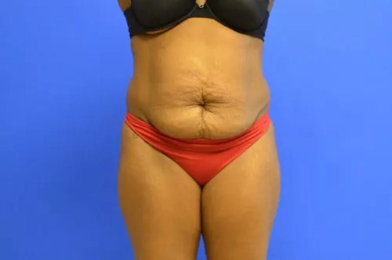 Drainless Tummy Tuck Before & After Gallery - Patient 231578 - Image 5