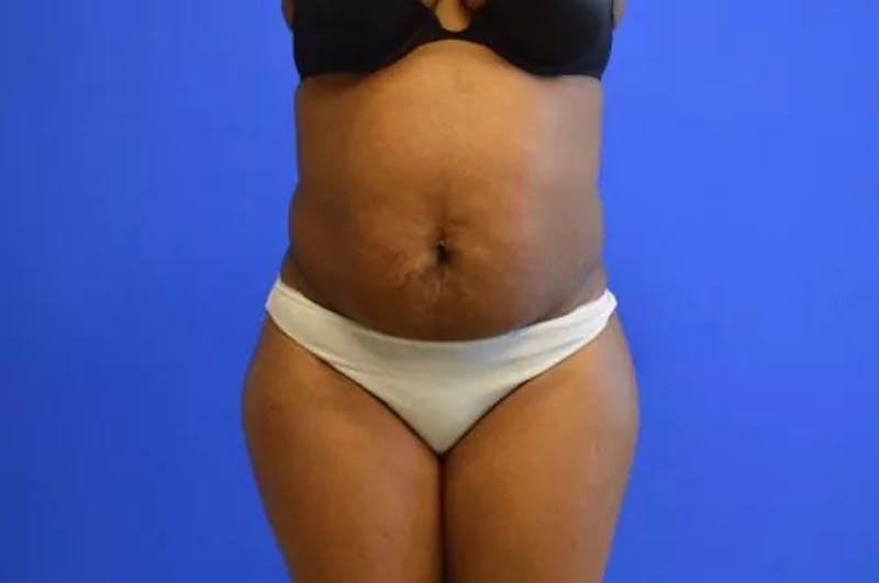 Drainless Tummy Tuck Before & After Gallery - Patient 364200 - Image 1
