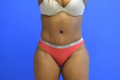 Drainless Tummy Tuck Before & After Gallery - Patient 364200 - Image 2