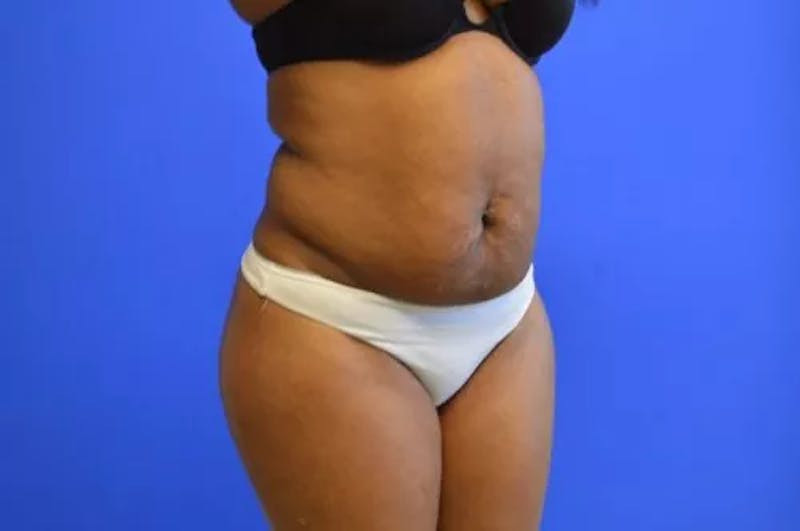 Drainless Tummy Tuck Before & After Gallery - Patient 364200 - Image 3