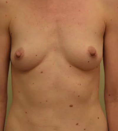 Breast Augmentation Before & After Gallery - Patient 946768 - Image 1