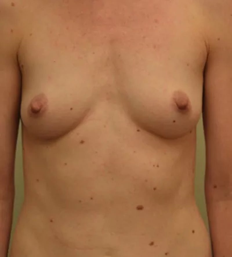 Breast Augmentation Before & After Gallery - Patient 946768 - Image 1