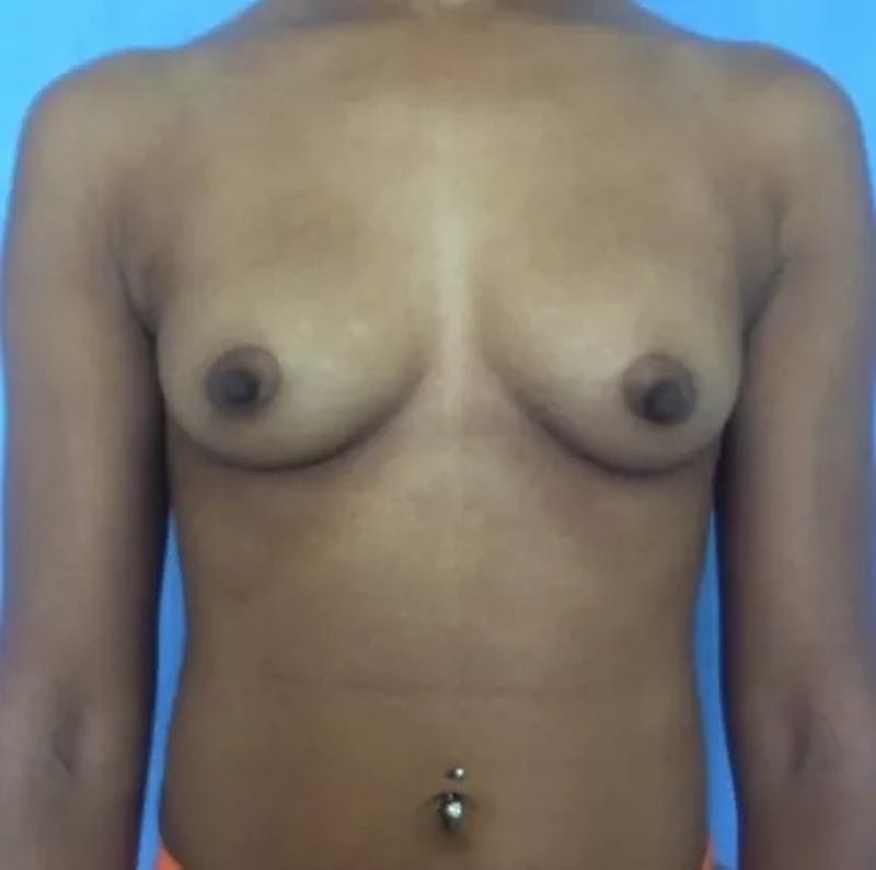 Breast Augmentation Before & After Gallery - Patient 969493 - Image 1