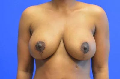 Breast Lift with Implants Before & After Gallery - Patient 187567 - Image 2