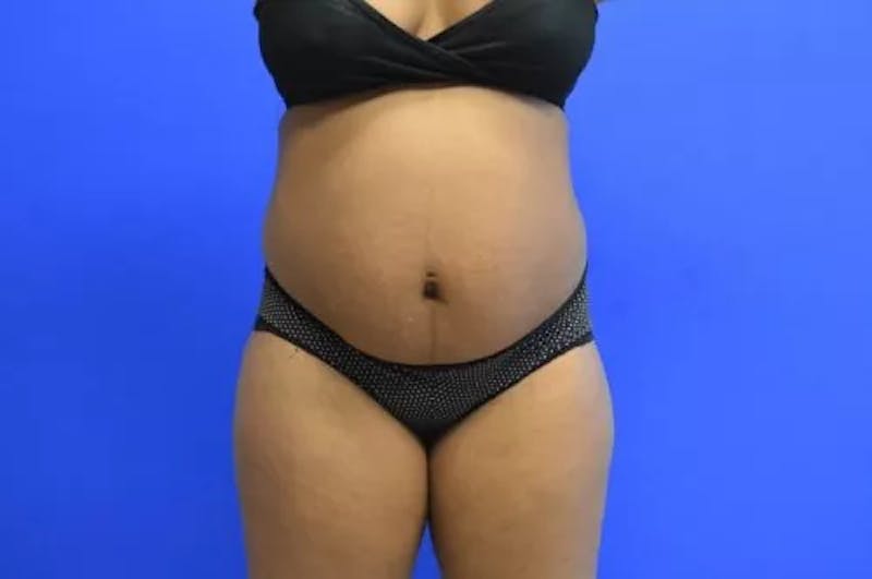 Drainless Tummy Tuck Before & After Gallery - Patient 204751 - Image 1