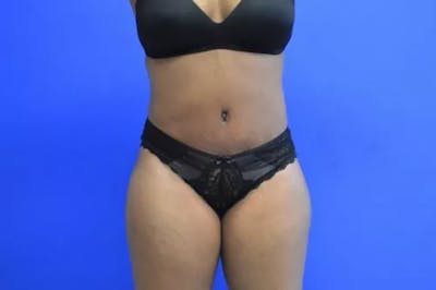 Drainless Tummy Tuck Before & After Gallery - Patient 204751 - Image 2