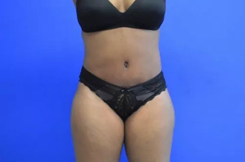 Drainless Tummy Tuck Before & After Gallery - Patient 204751 - Image 2