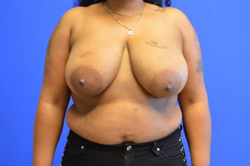 Breast Reduction with Lift Before & After Gallery - Patient 906866 - Image 1