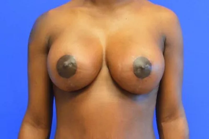Breast Lift with Implants Before & After Gallery - Patient 357340 - Image 2