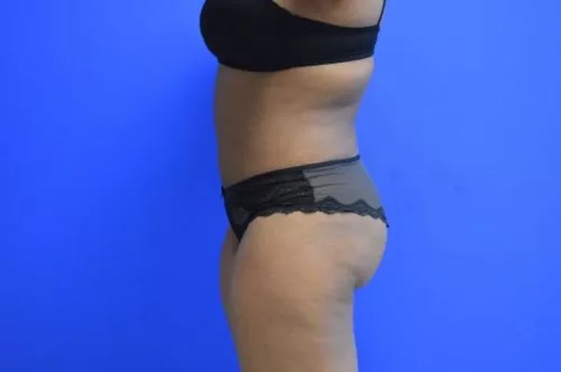 Drainless Tummy Tuck Before & After Gallery - Patient 204751 - Image 6