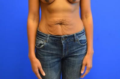 Drainless Tummy Tuck Before & After Gallery - Patient 103136 - Image 1