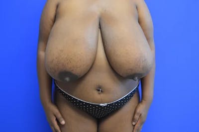 Breast Reduction with Lift Before & After Gallery - Patient 277076 - Image 1